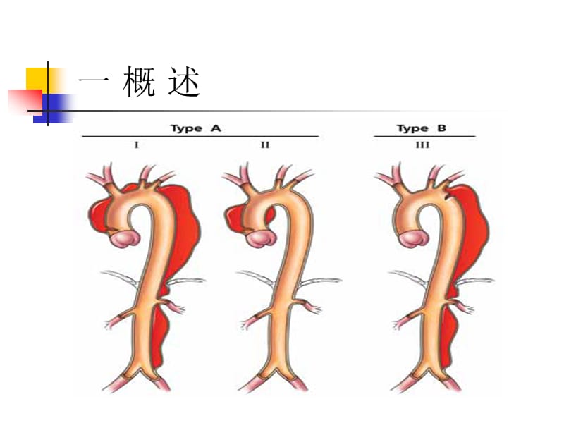 主动脉夹层致急性心梗的识别与处理ppt课件.ppt_第3页