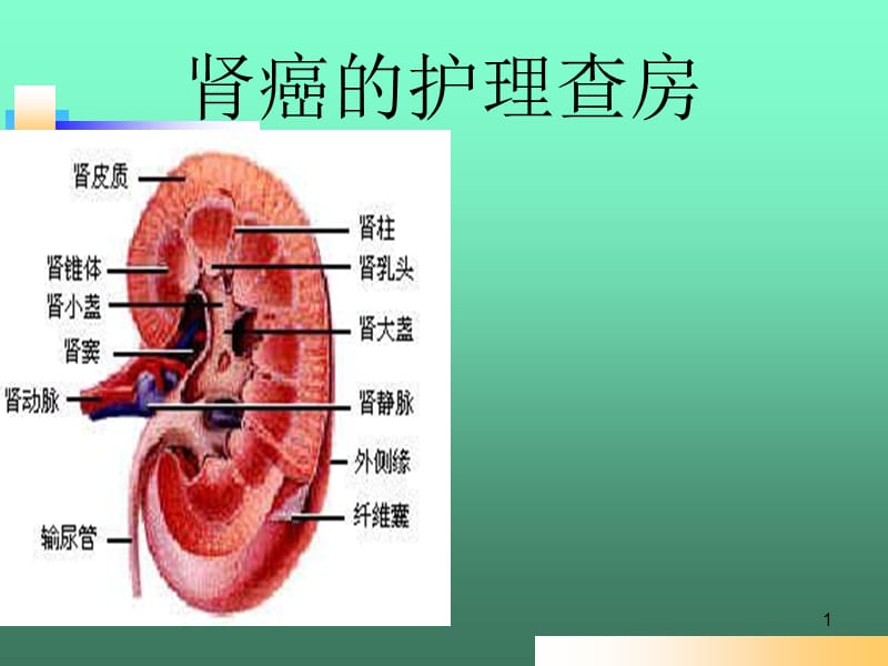 肾癌的护理查房ppt课件_第1页