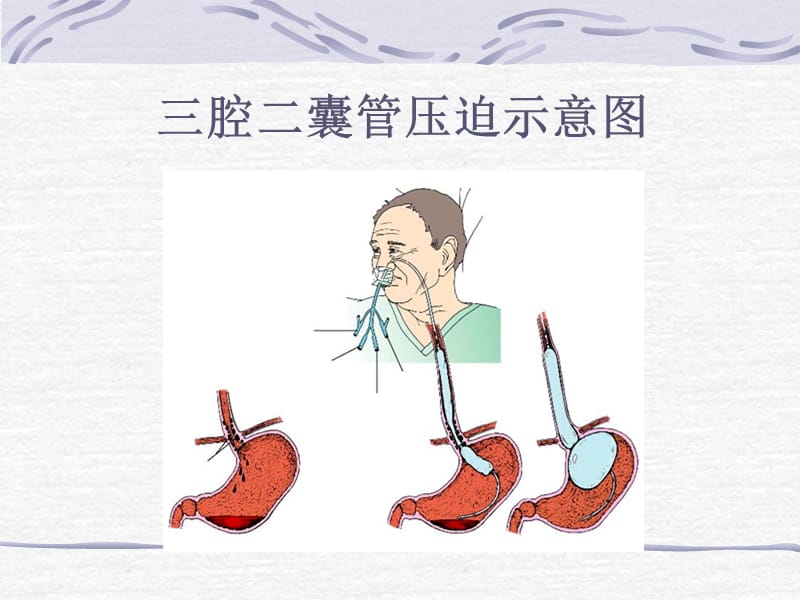 三腔二囊管的应用和护理PPT课件.ppt_第2页