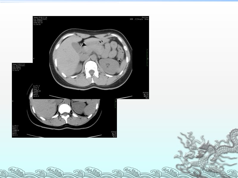 肾上腺常见病变CT1ppt课件_第3页
