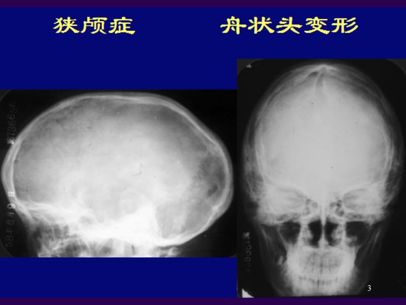 神经系统异常影像学表现和基本病变ppt课件_第3页