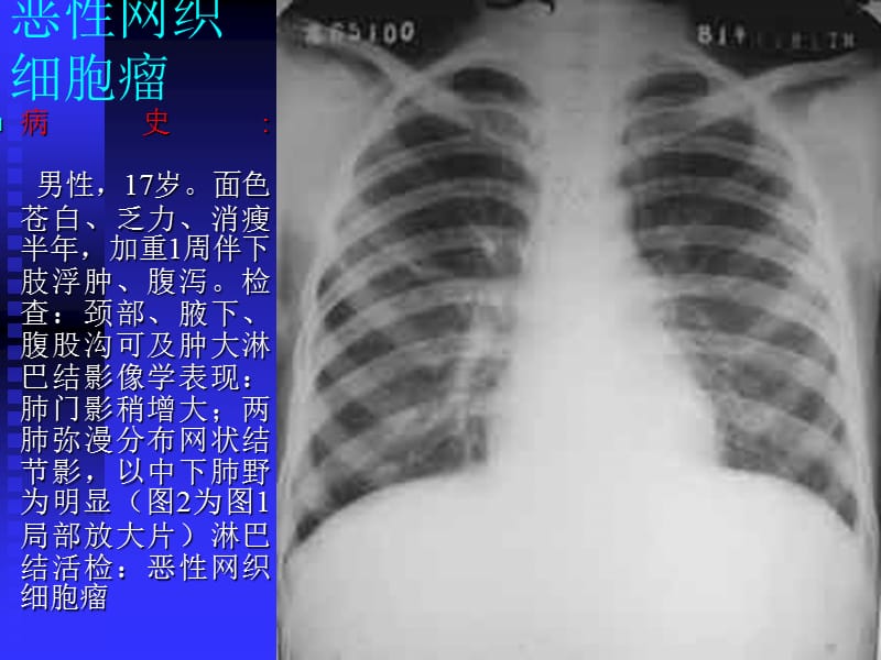 《肺癌诊断》PPT课件.ppt_第2页