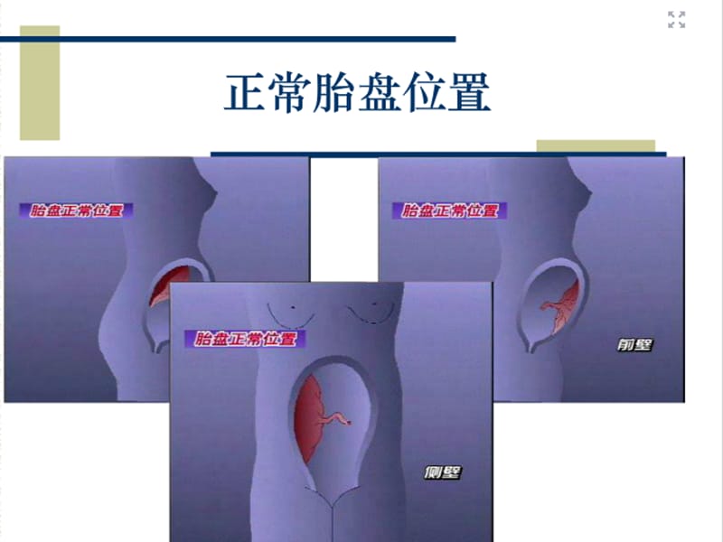 《前置胎盘的护理》ppt课件.ppt_第2页