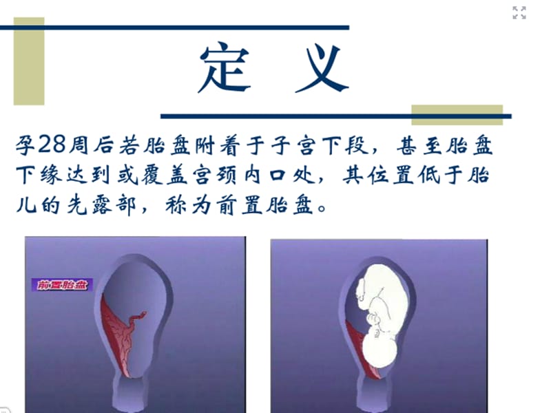 《前置胎盘的护理》ppt课件.ppt_第3页