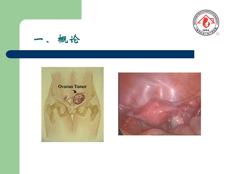 卵巢肿瘤（ovariantumor）-妇科教学课件.ppt_第2页