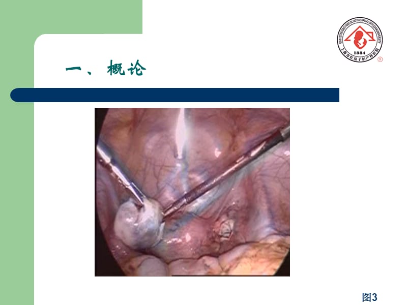 卵巢肿瘤（ovariantumor）-妇科教学课件.ppt_第3页