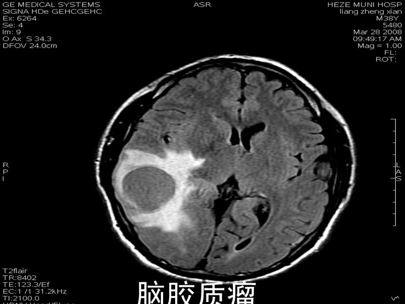 脑胶质瘤的护理PPT课件.ppt_第3页