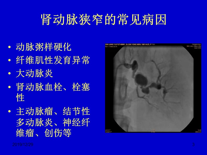 肾血管性高血压的诊断与治疗.ppt_第3页