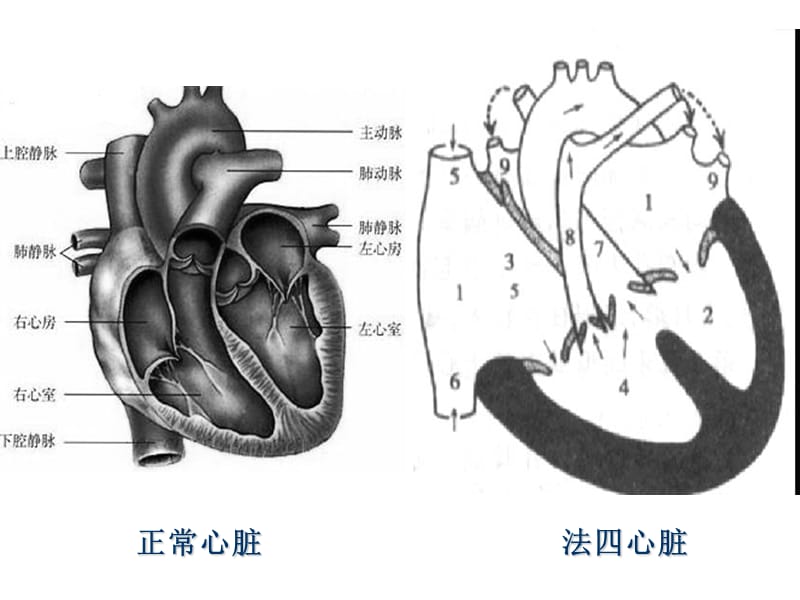 法洛氏四联症术后护理常规ppt课件.ppt_第3页