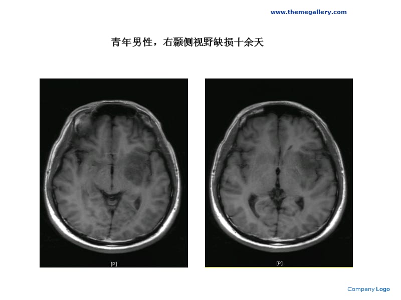 肿瘤样脱髓鞘病变课件.ppt_第2页