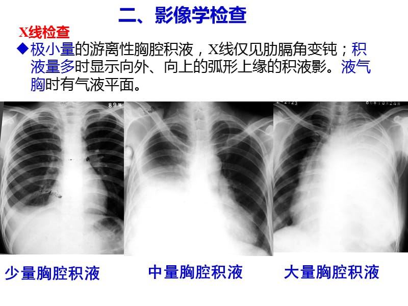 胸膜疾病及慢阻肺本科内科护理临床部分ppt课件.ppt_第2页