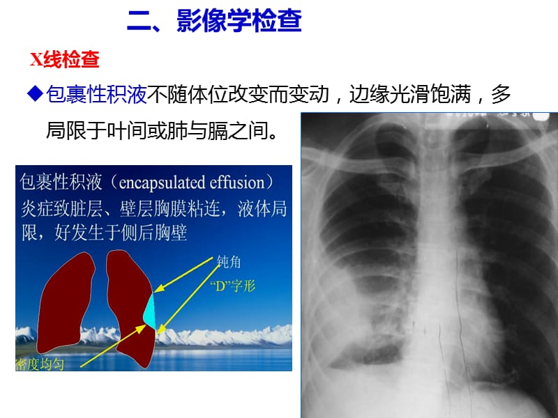 胸膜疾病及慢阻肺本科内科护理临床部分ppt课件.ppt_第3页