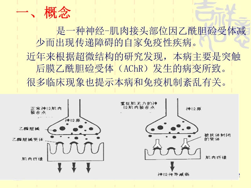 重症肌无力的护理ppt课件.ppt_第2页