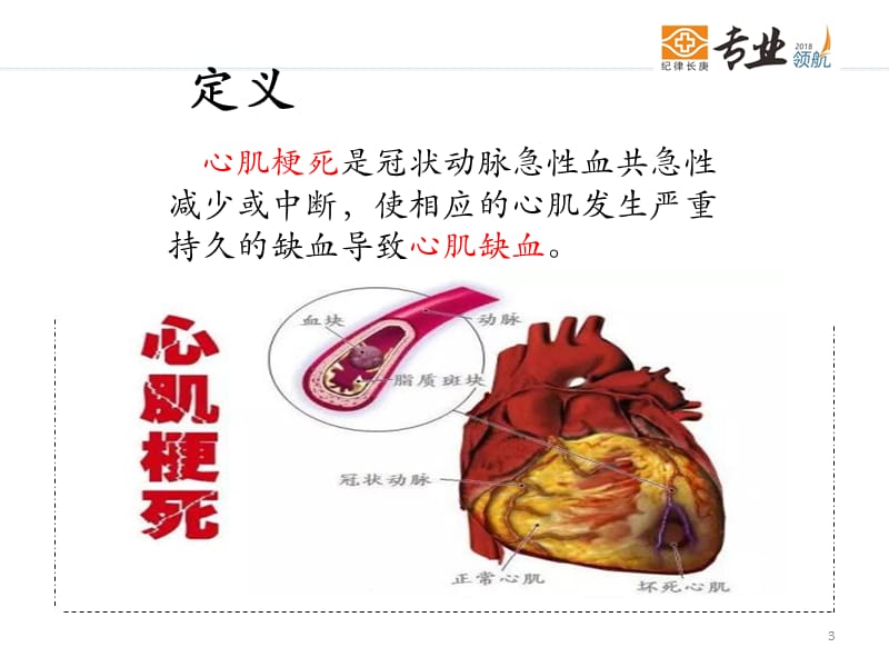 心肌梗死的护理ppt课件.ppt_第3页