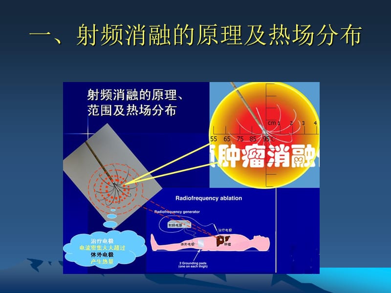 肿瘤射频消融治疗的创新技术课件.ppt_第2页