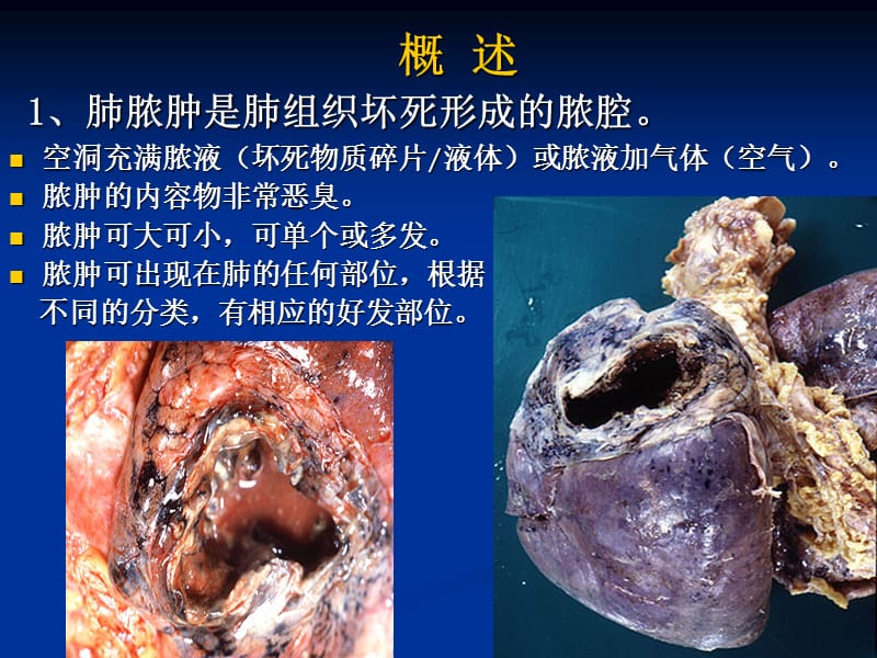 肺脓肿、支气管扩张本科内科护理临床部分ppt课件.ppt_第2页