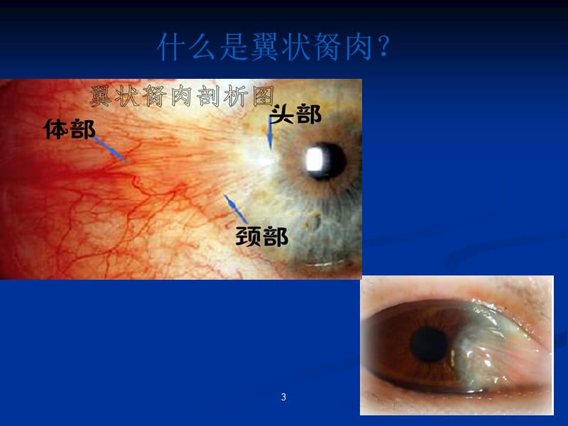 翼状胬肉护理介绍_第3页