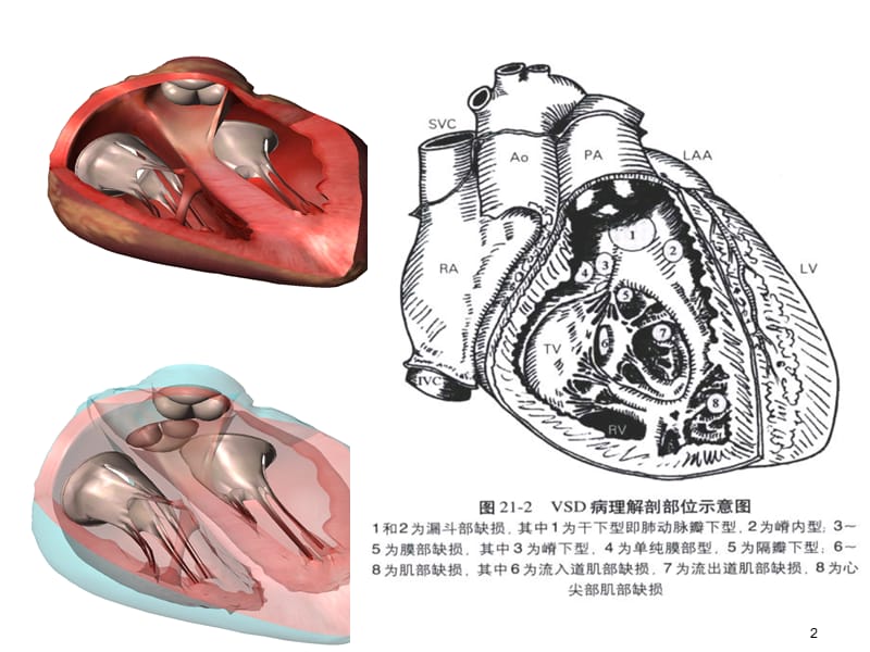 室间隔缺损分型及相关鉴别ppt课件_第2页