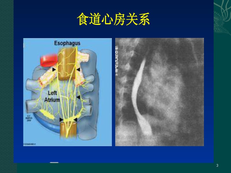 食道调搏术ppt课件_第3页