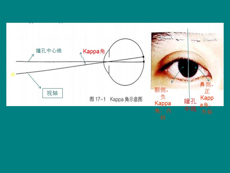 斜视几个概念)_第3页