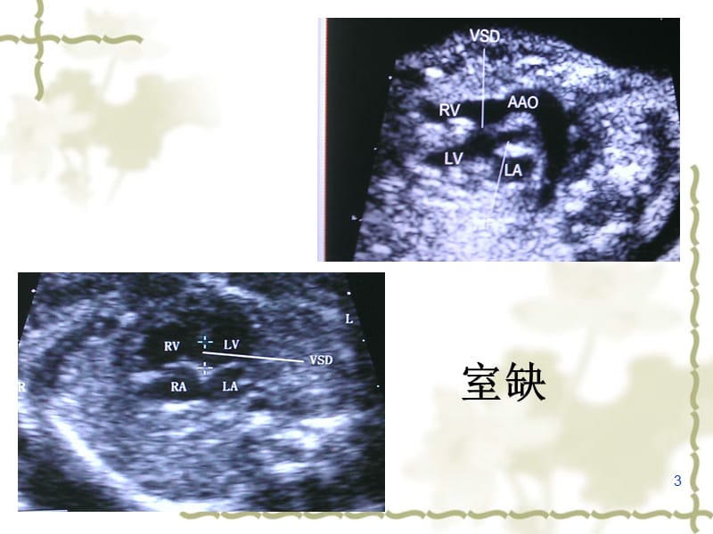 胎儿心脏畸形超声表现ppt课件_第3页