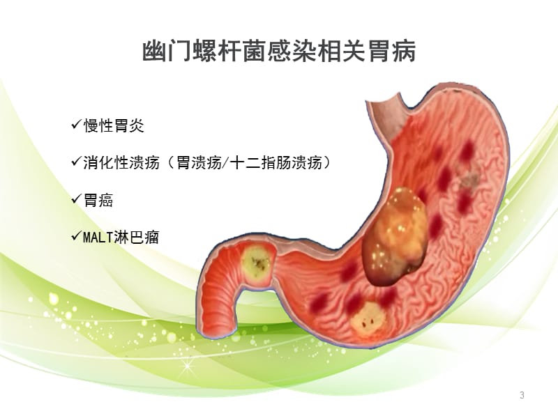 碳13呼气试验检测幽门螺杆菌ppt课件_第3页