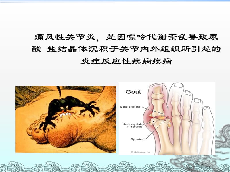 痛风性关节炎的诊断及治疗ppt课件_第3页