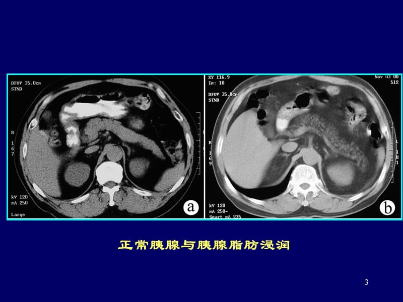 胰腺CT诊断ppt课件_第3页