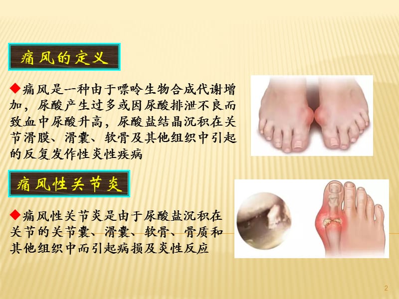 痛风性关节炎的中西医结合诊疗ppt课件_第2页