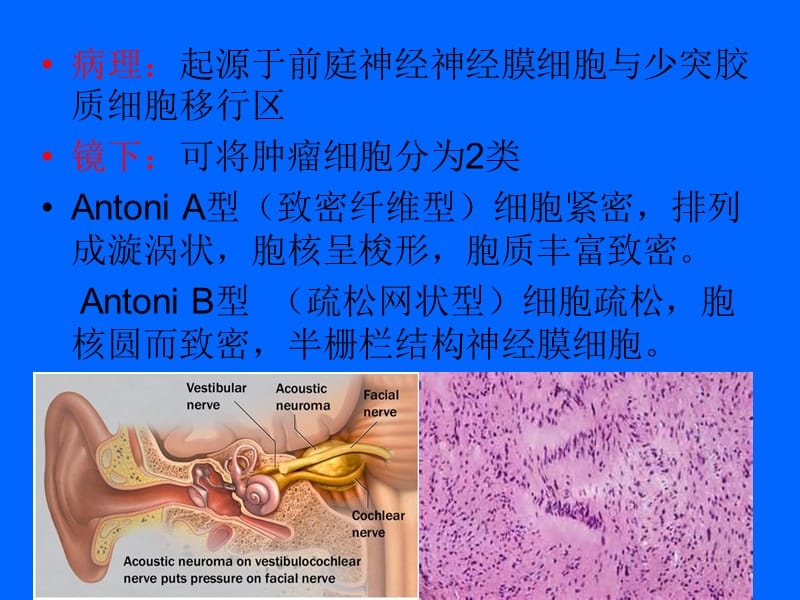 听神经瘤ppt课件_第3页