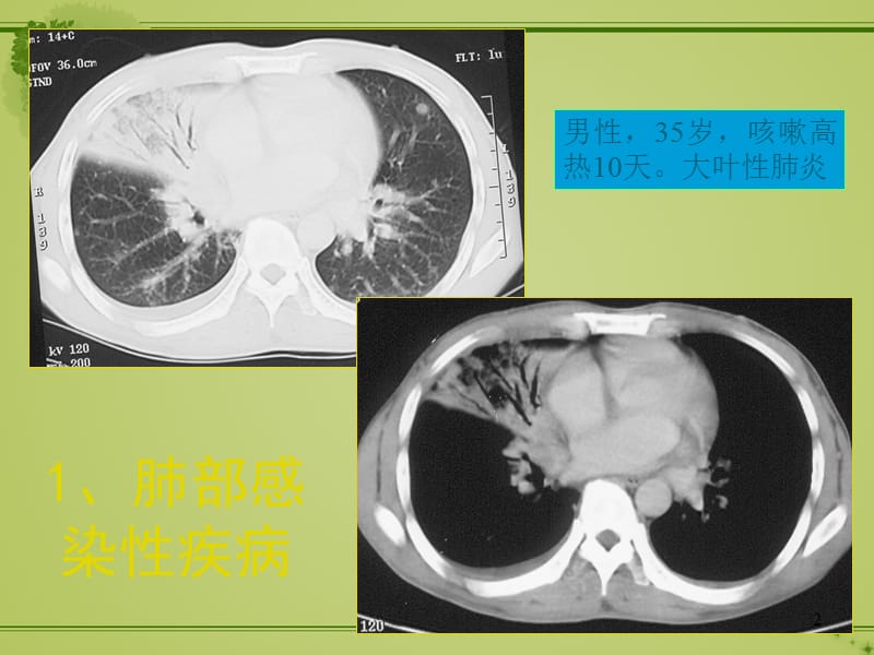 胸部CTppt课件_第2页