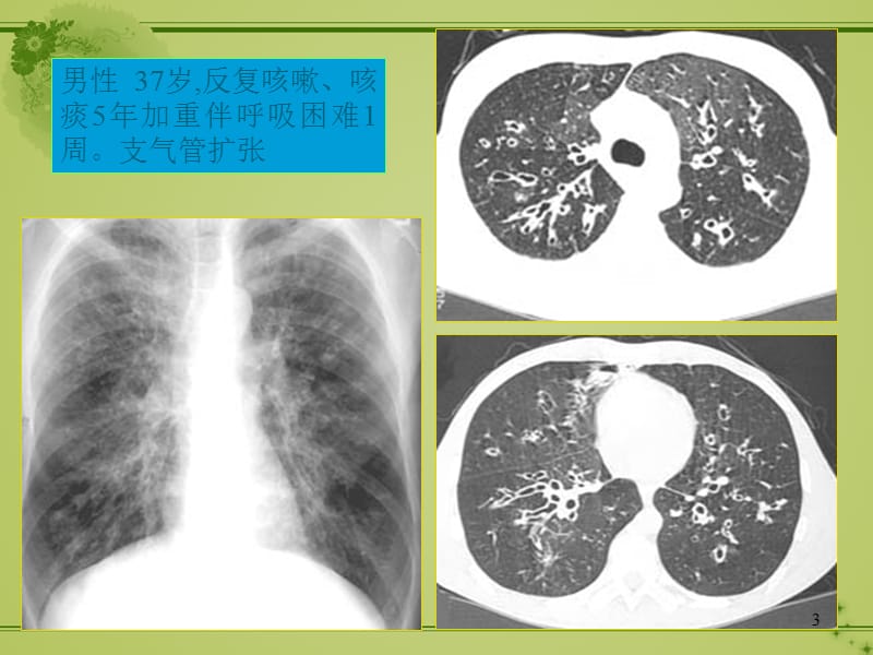 胸部CTppt课件_第3页