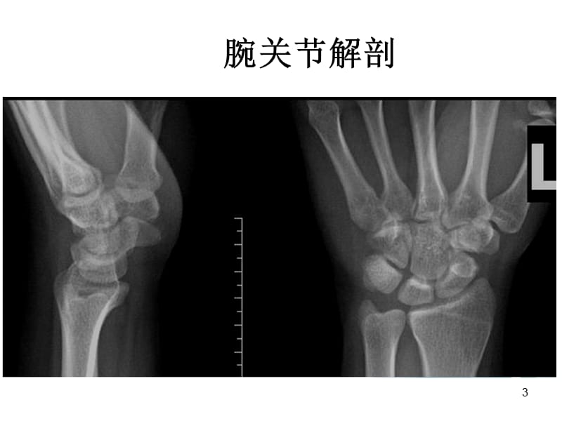 腕关节X线解剖及常见骨折诊断ppt课件_第3页