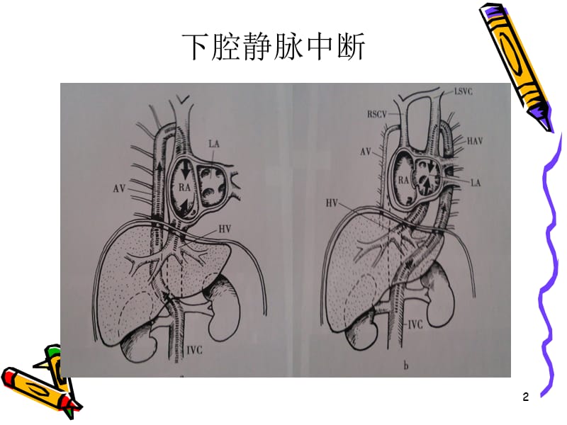 先心病的CTppt课件_第2页