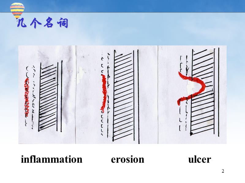 消化性溃疡ppt课件_第2页