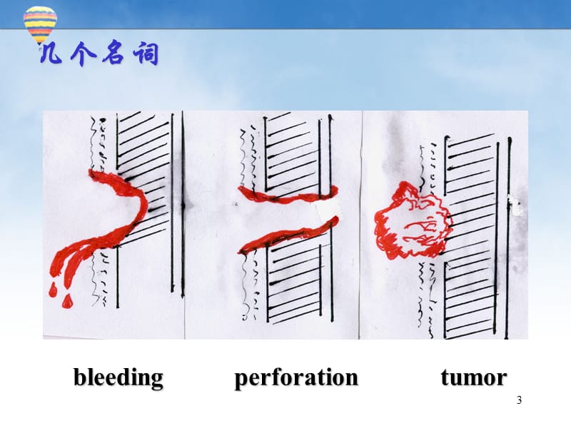 消化性溃疡ppt课件_第3页