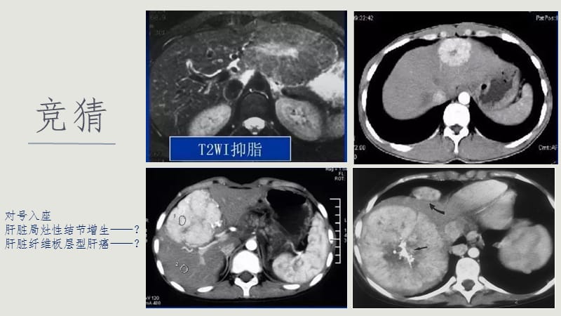 纤维板层型肝癌ppt课件_第2页
