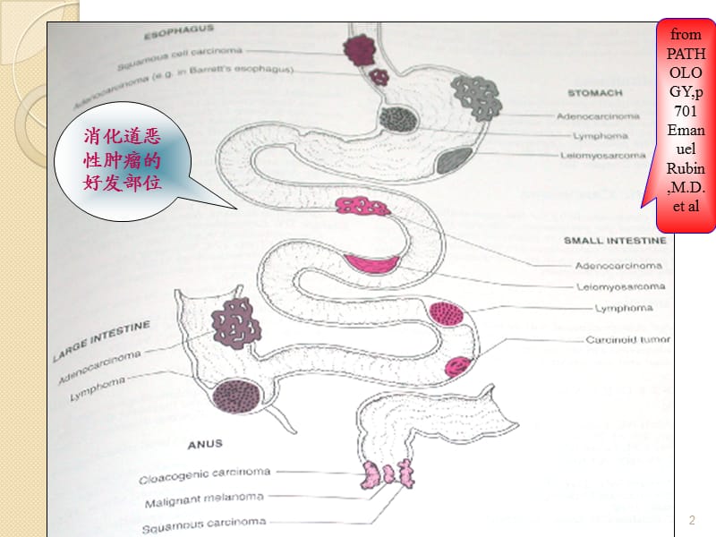 消化系统常见肿瘤ppt课件_第2页