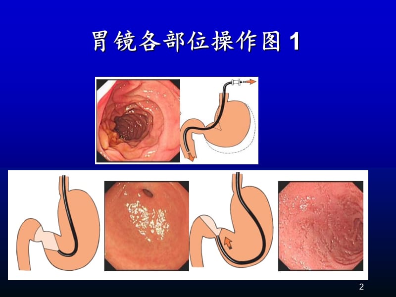 消化内镜诊疗进展ppt课件_第2页