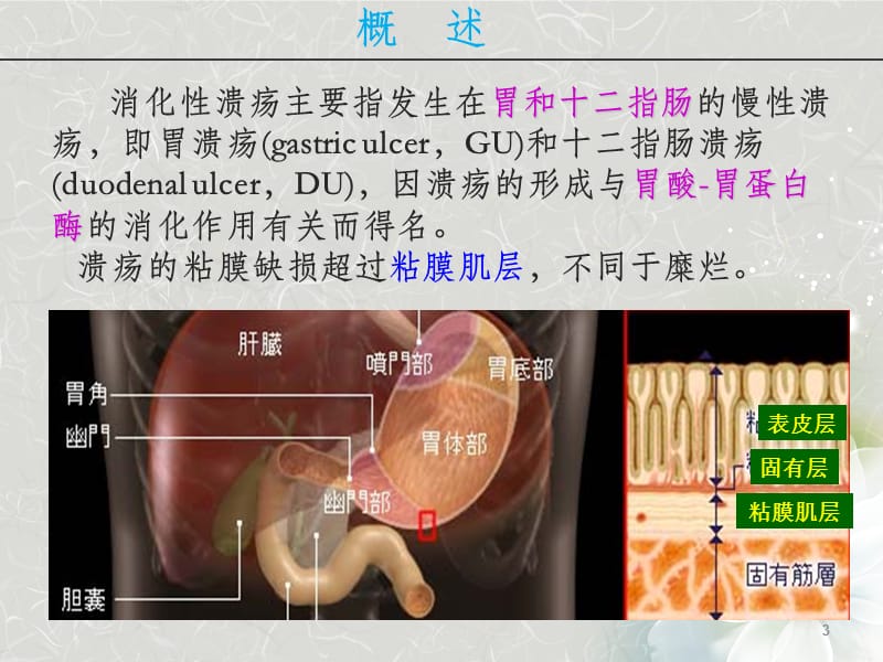 消化性溃疡新ppt课件_第3页