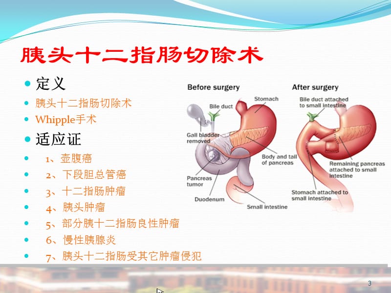 胰腺外科常用手术术式PPT课件_第3页