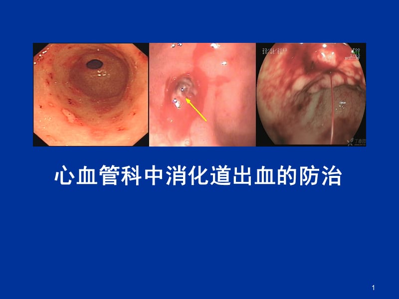 心血管疾病中消化道出血的防治ppt课件_第1页