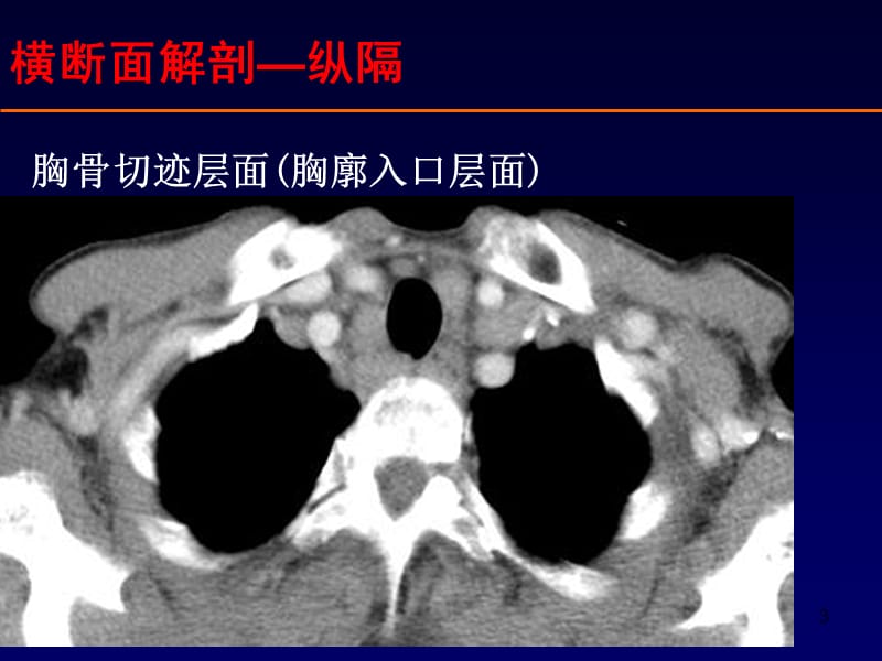 胸部纵膈断面影像解剖ppt课件_第3页