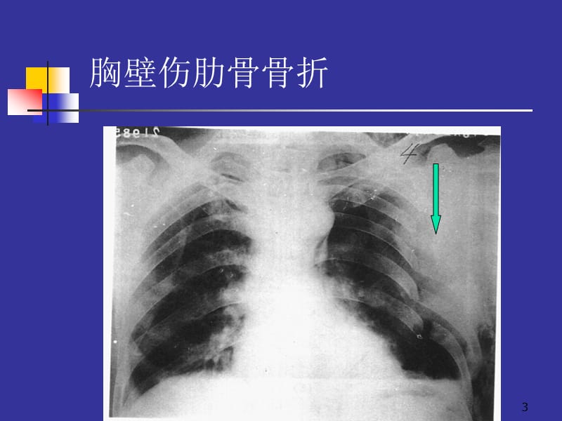 胸部CT课件之胸部外伤ppt课件_第3页