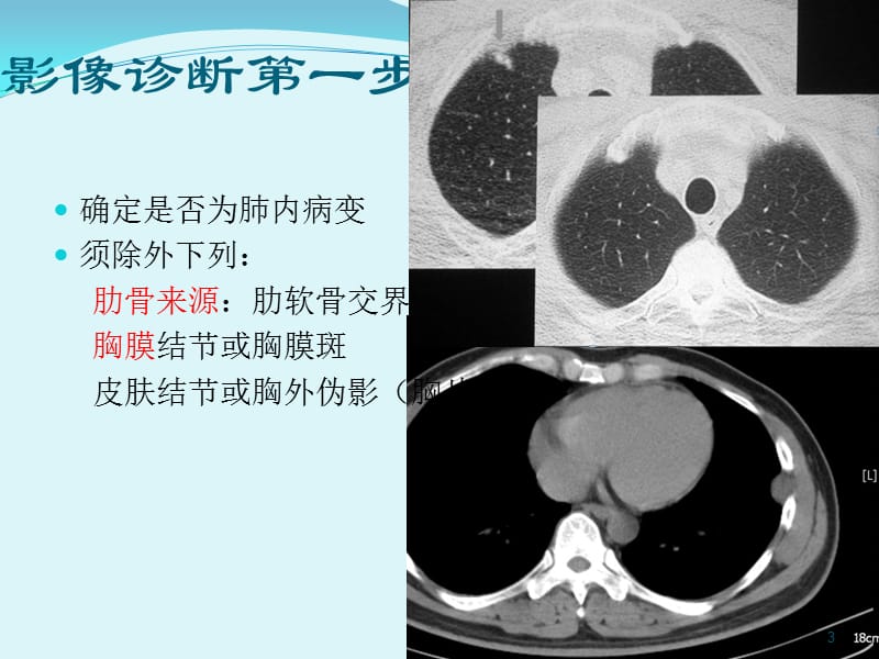 胸部CT肺内孤立性结节ppt课件_第3页