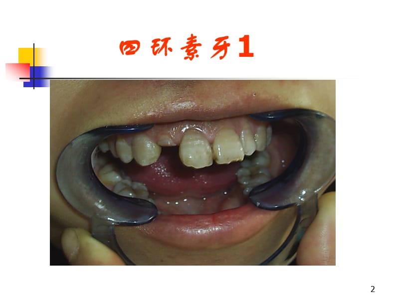 牙体病ppt课件_第2页
