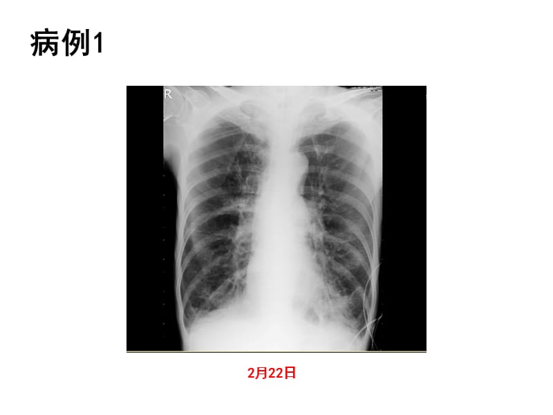 严重高碳酸血症的处理ppt课件_第3页