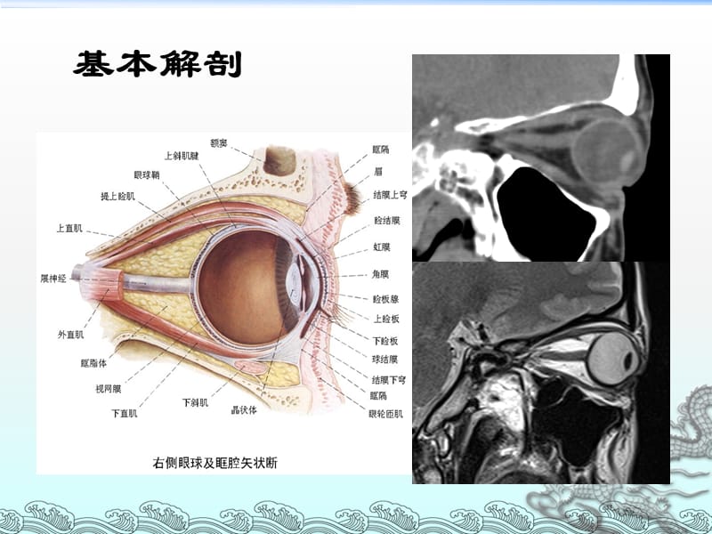 眼眶常见肿瘤的影像诊断ppt课件_第2页