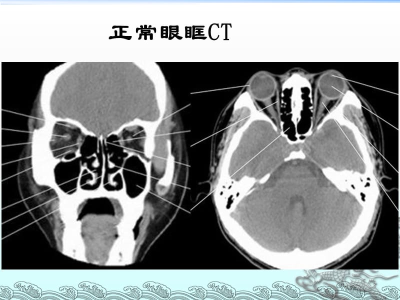 眼眶常见肿瘤的影像诊断ppt课件_第3页