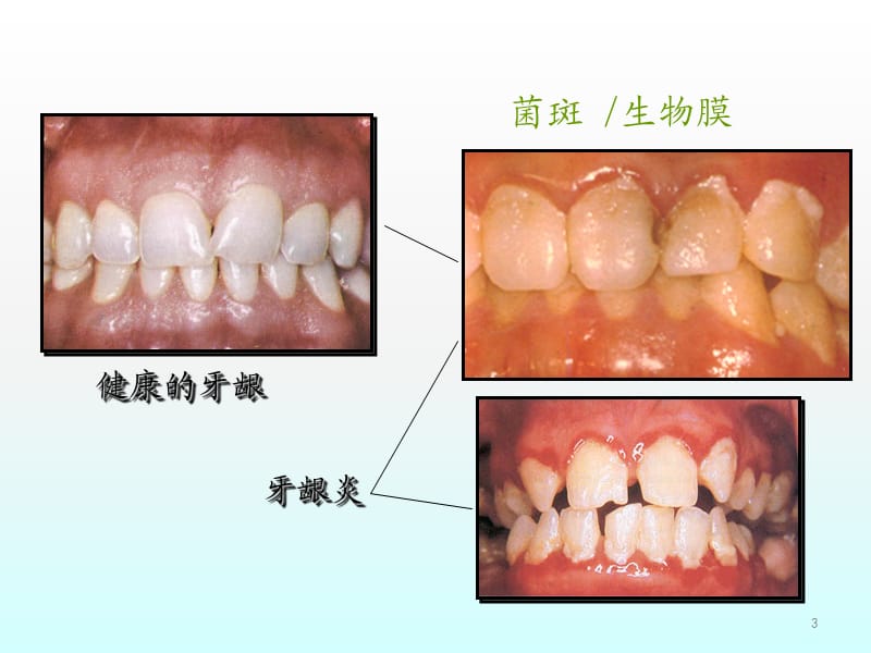 牙周炎与全身疾病慢病发言ppt课件_第3页